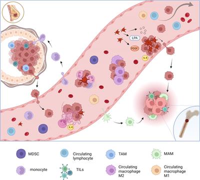 Circulating inflammatory cells in patients with metastatic breast cancer: Implications for treatment